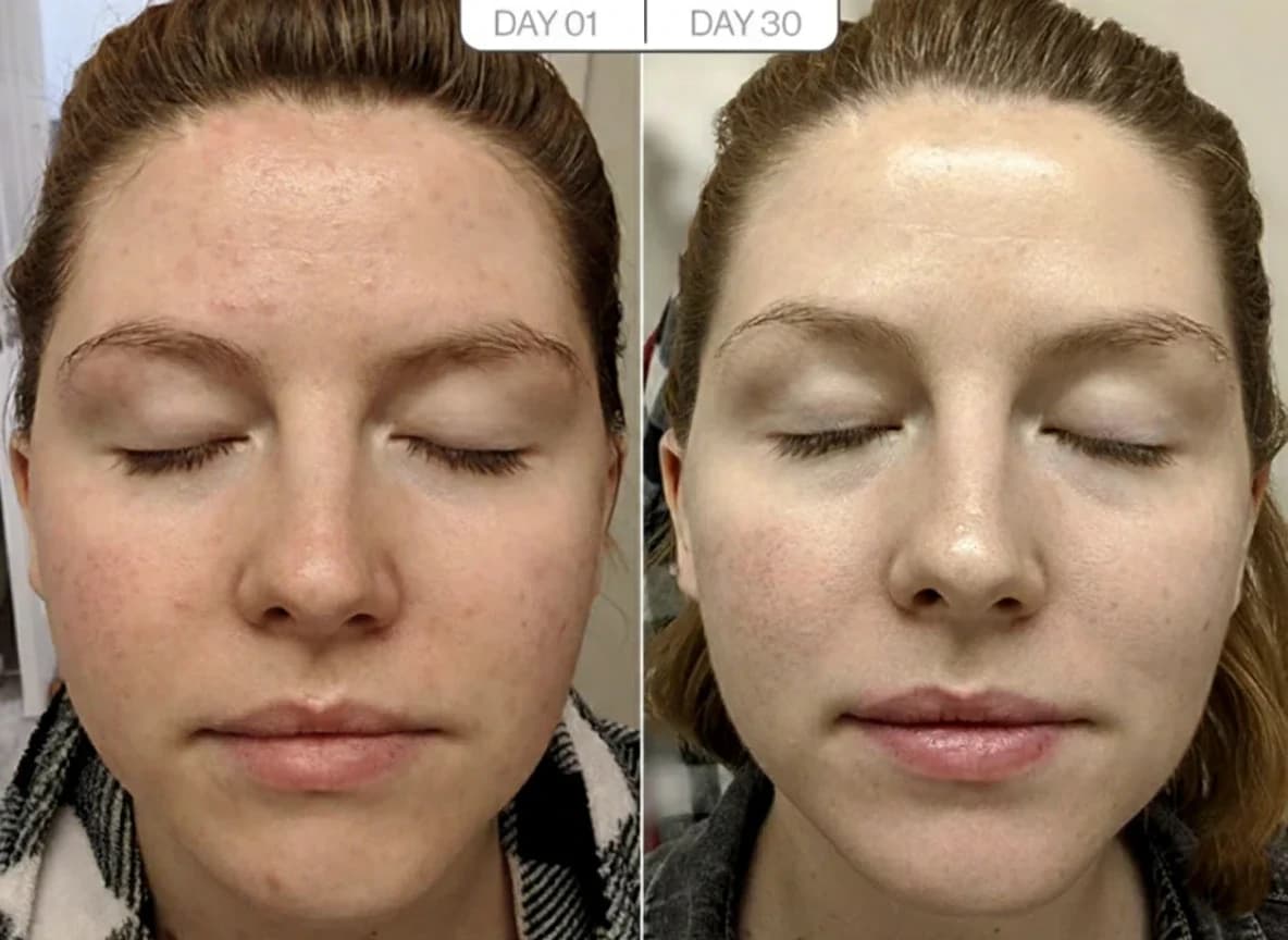Forehead Lines