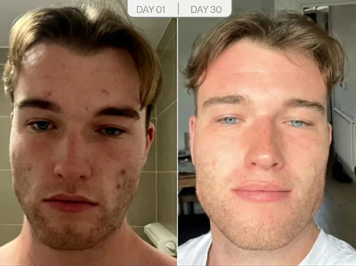 Jawline Sculpting